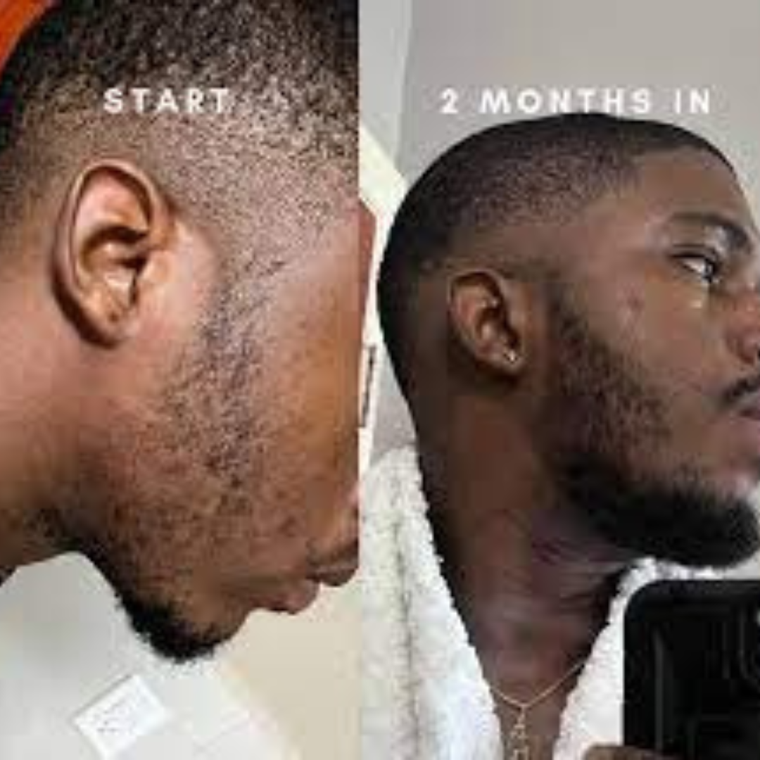 Hair Extra Boost Minox 5% with Biotin (& Derma roller) 6 months