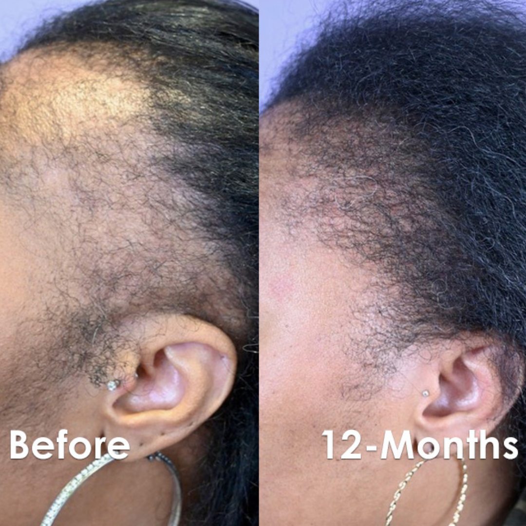 Hair Extra Boost Minox 5% with Biotin (& Derma roller) 6 months