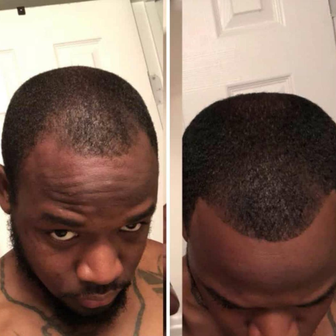 Hair Extra Boost Minox 5% with Biotin (& Derma roller) 6 months