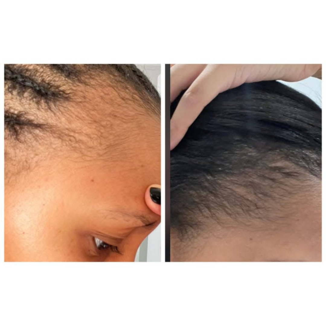 Hair Extra Boost Minox 5% with Biotin (& Derma roller) 6 months